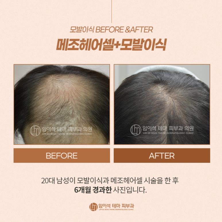 모발이식 Before&After와 이식 시 주의사항 관련 이미지 5