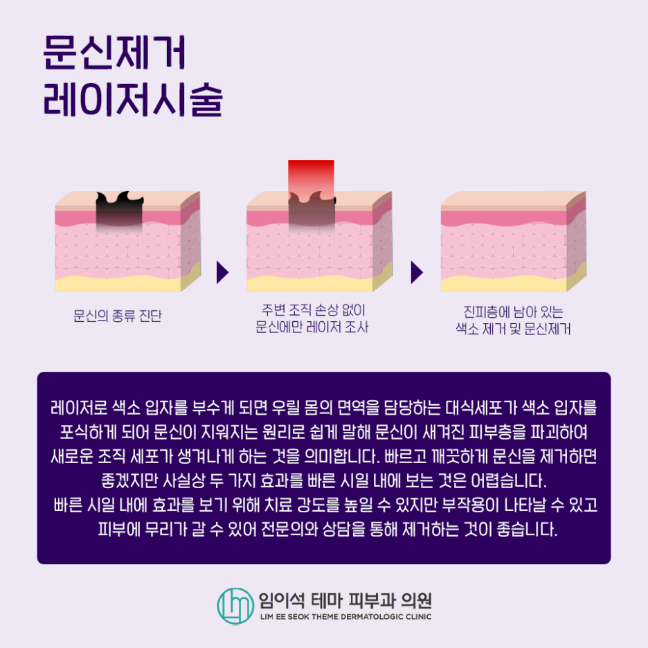 몸에 새긴 문신(타투) 제거 방법 관련 이미지 3