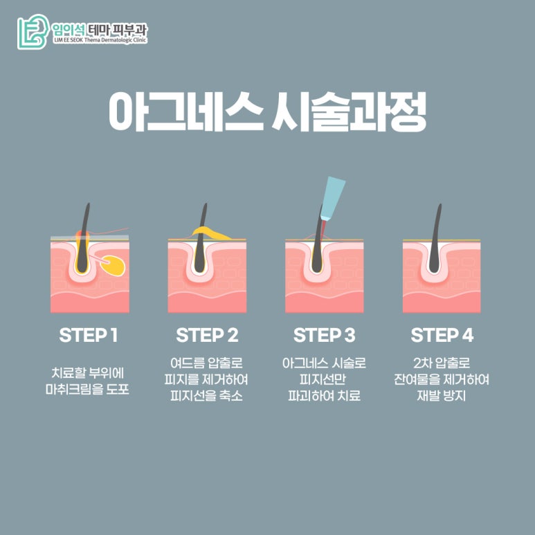 신사피부과 임이석피부과의 아그네스 레이저 치료법 관련 이미지 7