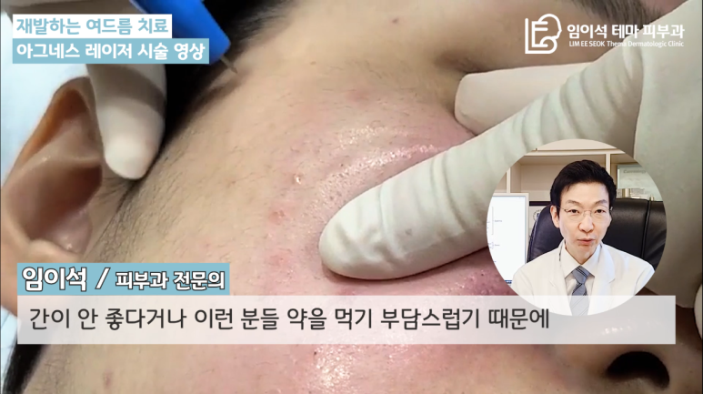 [Imi-seok Thema Dermatology YouTube Dr. Imi-seok Channel] Laser Treatment for Recurrent Acne image 7