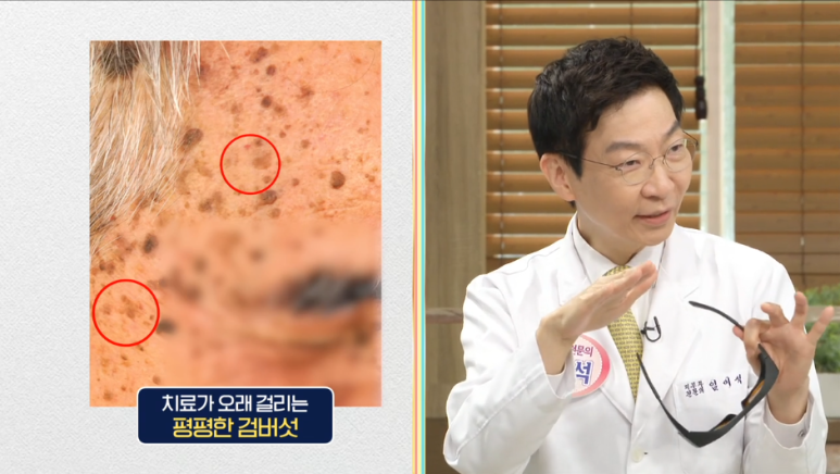 임이석테마피부과 기미를 없애는 법, 기미 레이저 전후 공개! MBC 기분좋은날 출연 관련 이미지 21