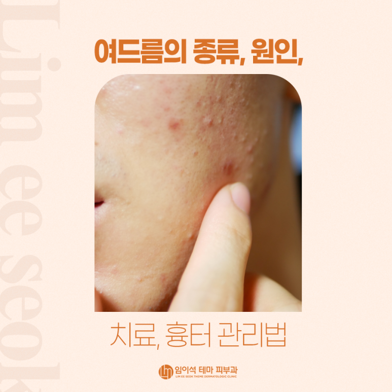 여드름의 종류, 원인, 치료, 흉터 관리법 관련 이미지 2