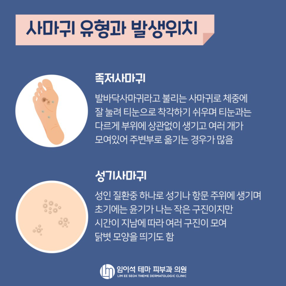 사마귀 원인과 치료법! 임이석 피부과에서 알려드립니다 관련 이미지 5
