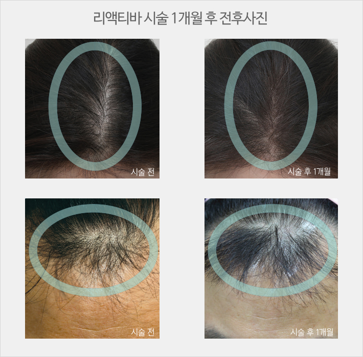 머리숱 풍성하게 관련 이미지 4