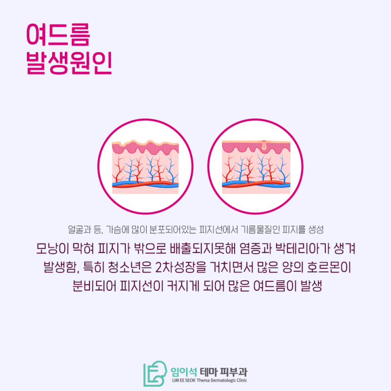[임이석테마피부과] 청소년기 여드름관리 방법! 관련 이미지 4