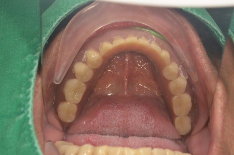 The Misconception That Full-Arch Implants Are Always Difficult for Patients with Diabetes image 13