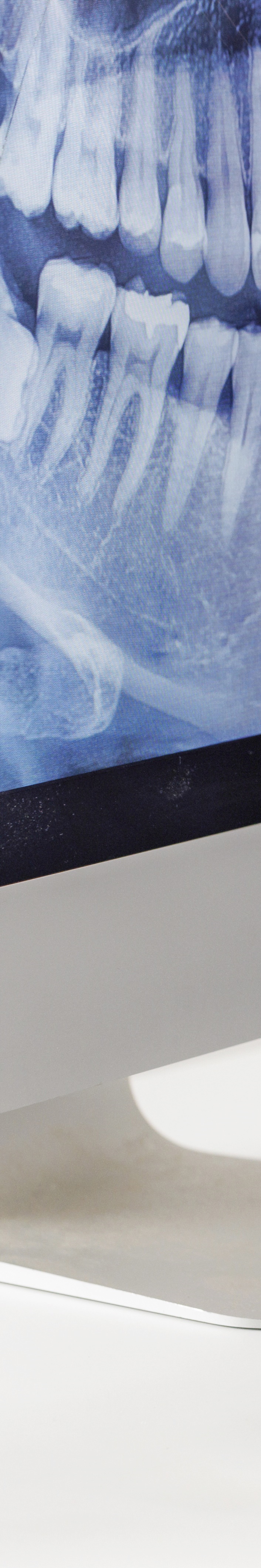 Understand the Side Effects of Maxillary Sinus Lifting Thoroughly and Respond Wisely image 24