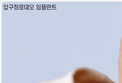 압구정로데오 임플란트 탄탄한 치아 유지는? 관련 이미지 9