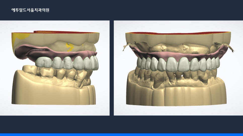 디지털 풀아치 임플란트 정말 두달이면 다 끝나나요? 관련 이미지 5