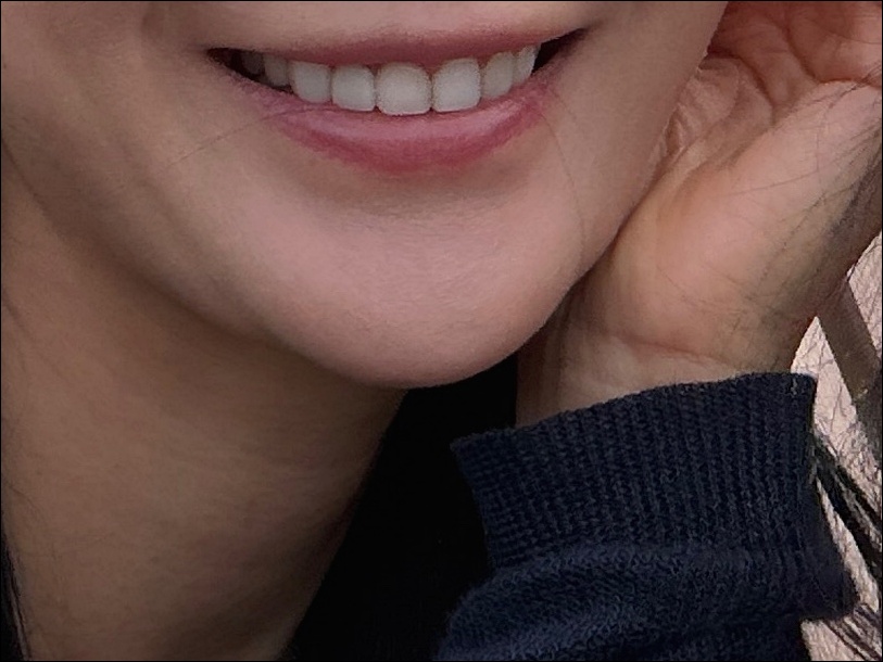 What Makes Apgujeong No-Prep Veneers Different? image 8