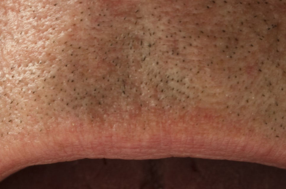 압구정로데오역 치과 불편한 틀니 대신 풀아치 임플란트! 관련 이미지 20