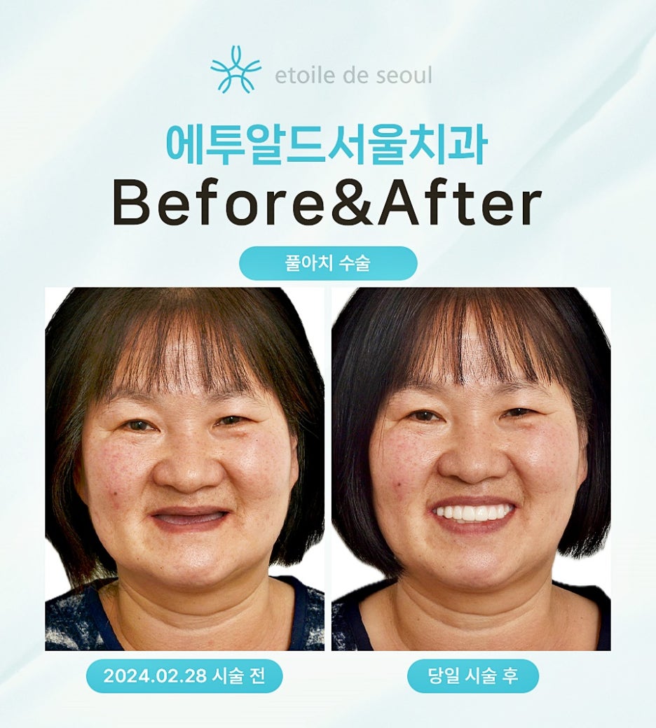 올온엑스 보험 전체 임플란트를 고려하나요 관련 이미지 7