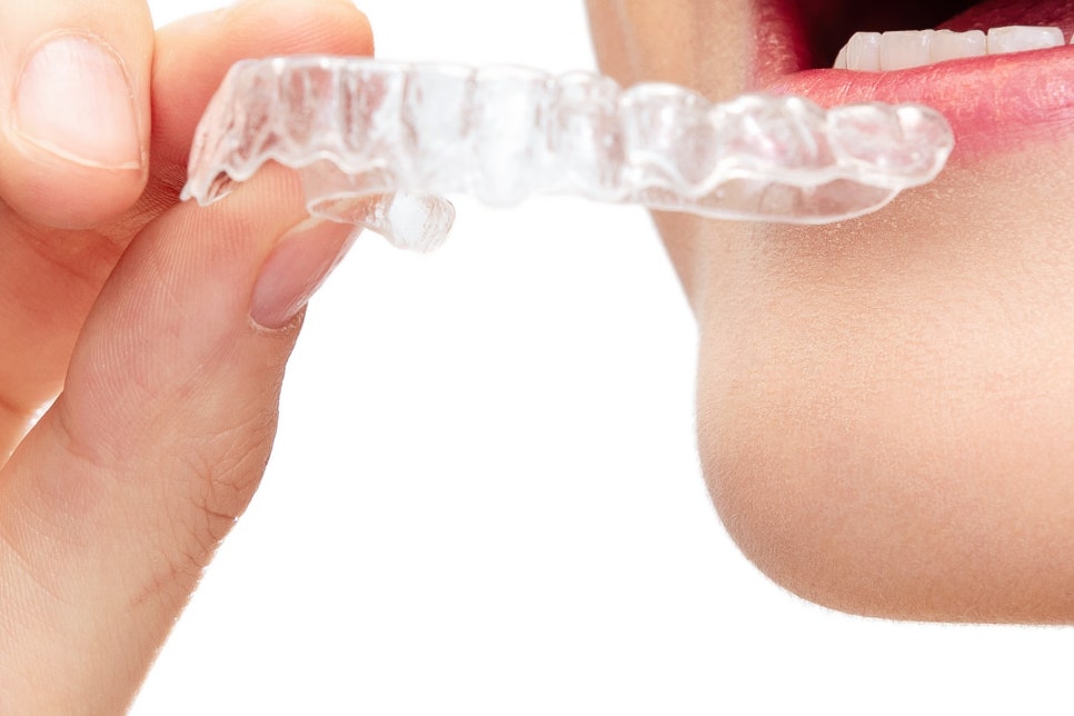 학동사거리 전악임플란트 치과 선택 시 이건 알아두자 관련 이미지 26