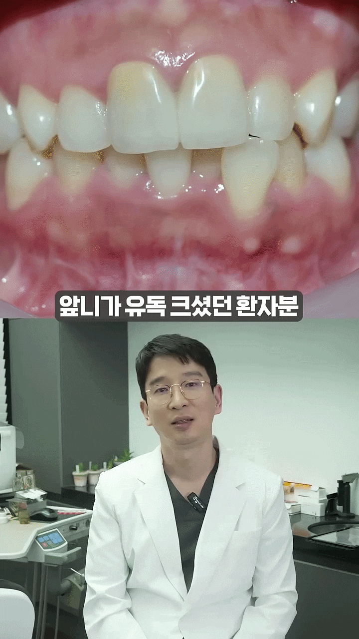 4 Reasons Why the Cost of No-Prep Veneers in Gangnam Varies image 5