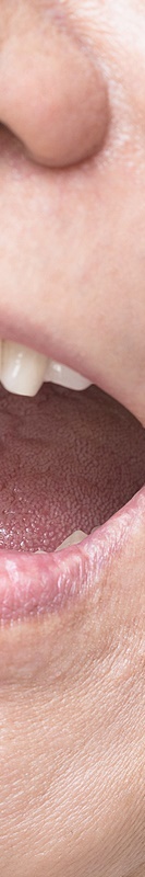 압구정치과 풀아치임플란트 회복기간 얼마나 필요할까 관련 이미지 37