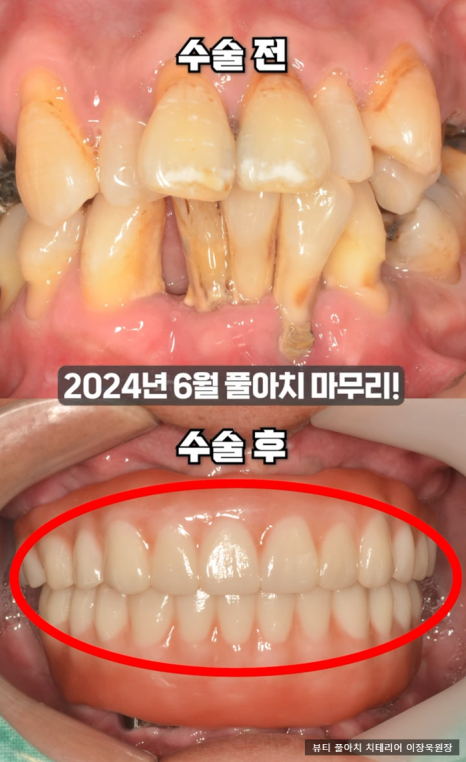 임플란트의 역사와 구조, 풀아치 임플란트 구조 차이점 비교 관련 이미지 14