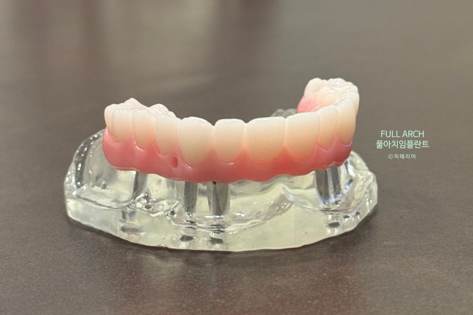 풀아치임플란트 무엇? full-arch Process 부작용과 주의할 점. 관련 이미지 3