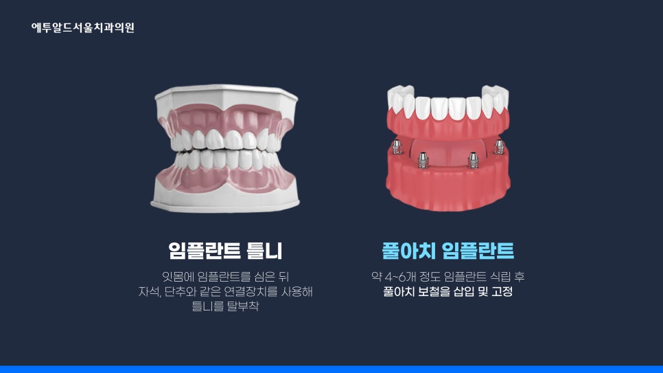 디지털 풀아치 임플란트 정말 두달이면 다 끝나나요? 관련 이미지 2