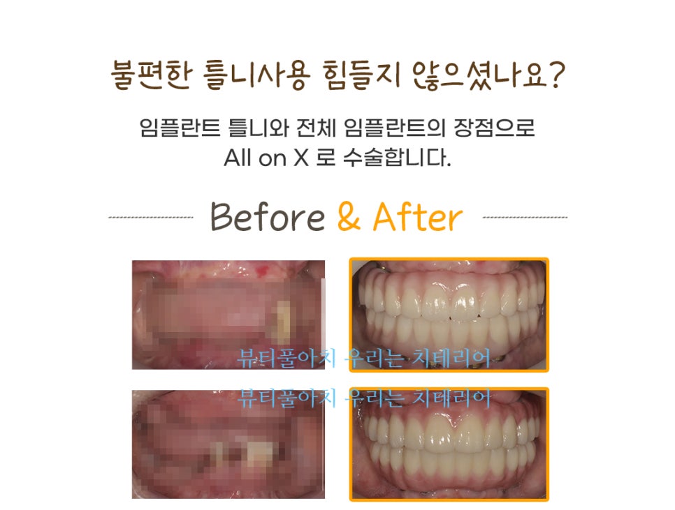 풀아치 임플란트 왜 풀아치정품보철 이어야 할까? 관련 이미지 6