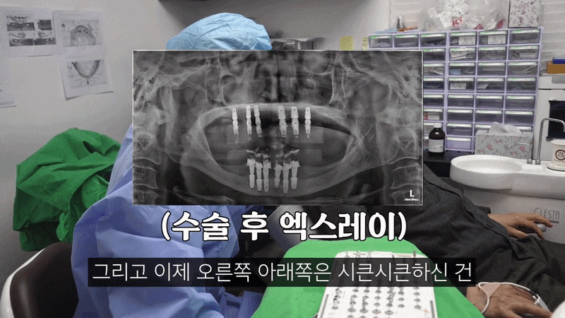 풀아치 임플란트 통증 걱정 때문에 망설이셨다면 치료 전에 알아야 할 5가지 관련 이미지 8