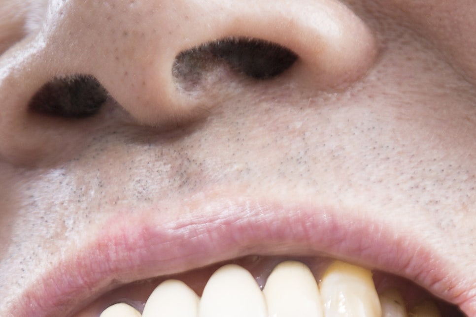 청담동 임플란트 불편함을 줄인 방법 관련 이미지 19