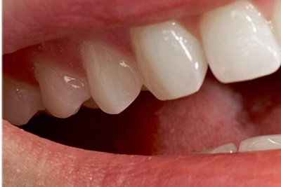 청담동치과 추천 앞니가 부러졌어요! 관련 이미지 22