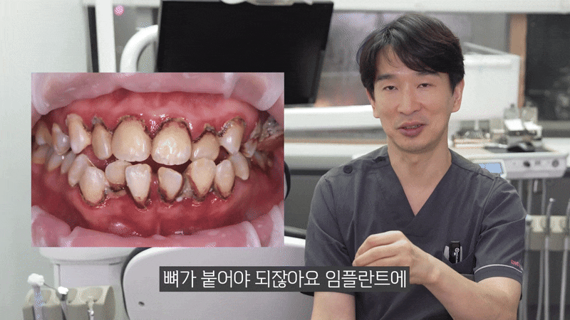 The Misconception That Full-Arch Implants Are Always Difficult for Patients with Diabetes image 7