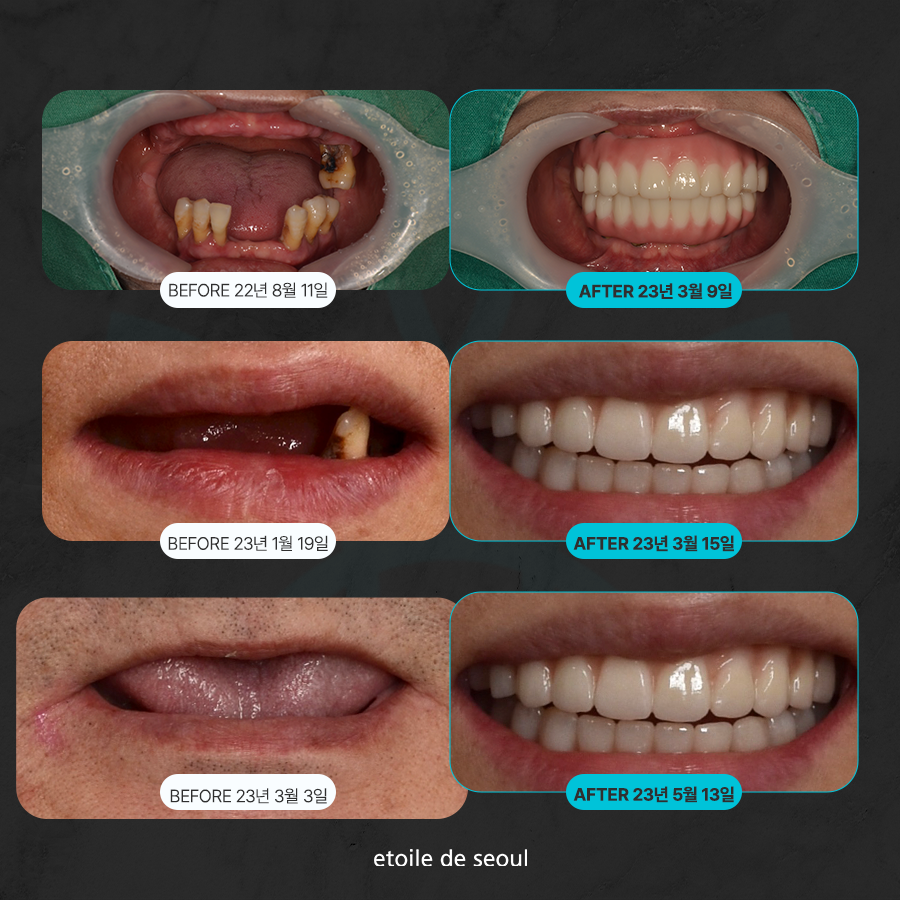 학동사거리 전악임플란트 치과 선택 시 이건 알아두자 관련 이미지 3