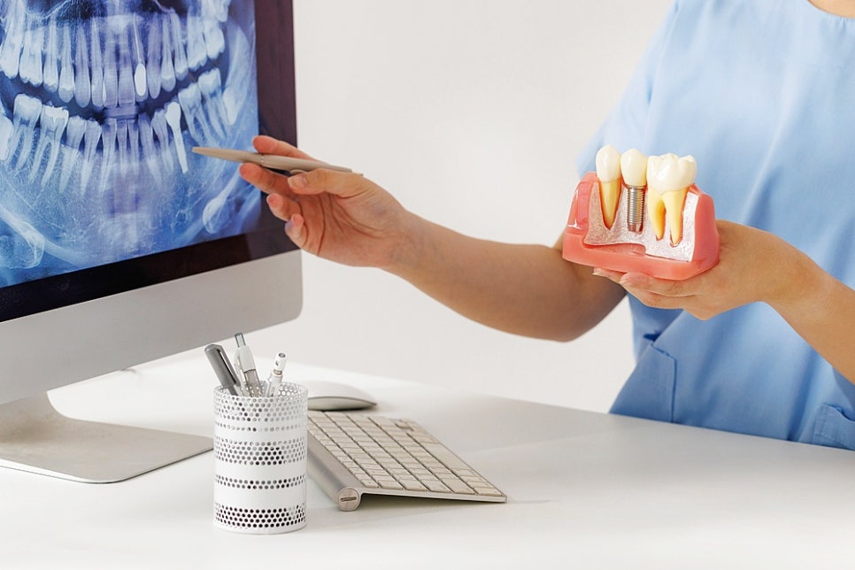 How Long Do Full-Mouth Dental Implants Last? image 11