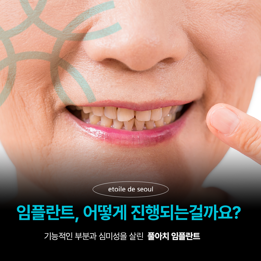 강남 65세이상임플란트 이것만 참고하자! 관련 이미지 2