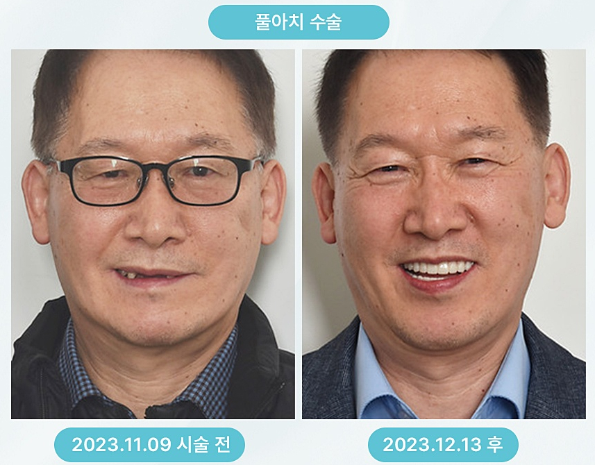 풀아치 임플란트 임플란트 틀니 차이, 상담 때 가장 많이 나온 질문 관련 이미지 11