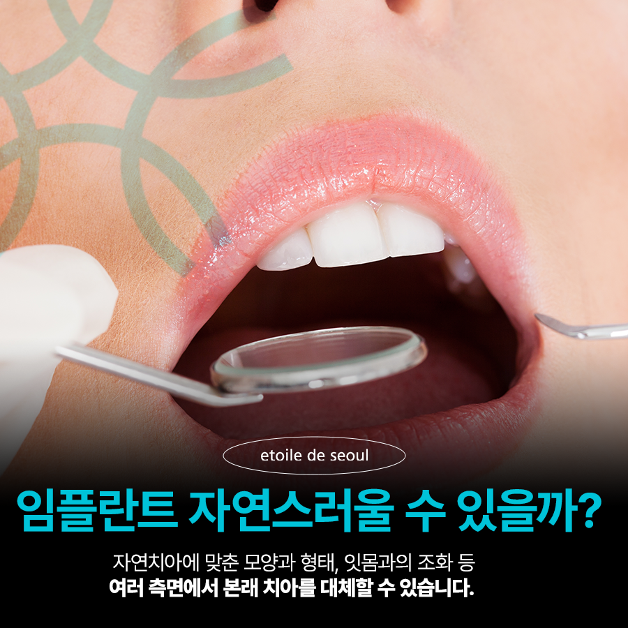 청담동치과 추천 앞니가 부러졌어요! 관련 이미지 3
