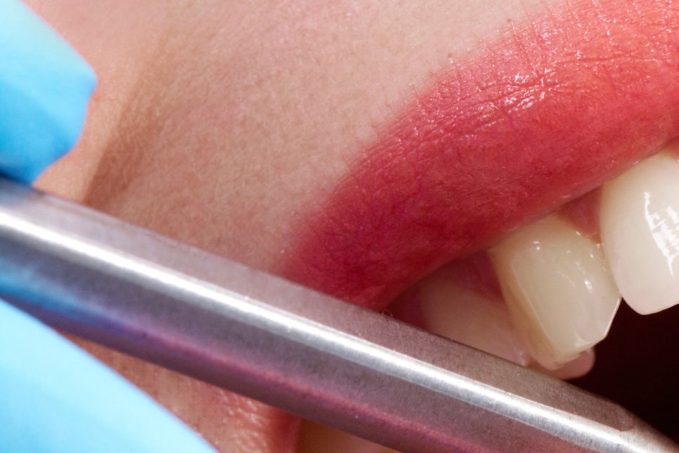 학동사거리 전악임플란트 치과 선택 시 이건 알아두자 관련 이미지 13