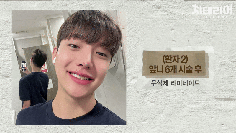 라미네이트 종류 비교 비용과 과정까지 안내 관련 이미지 8