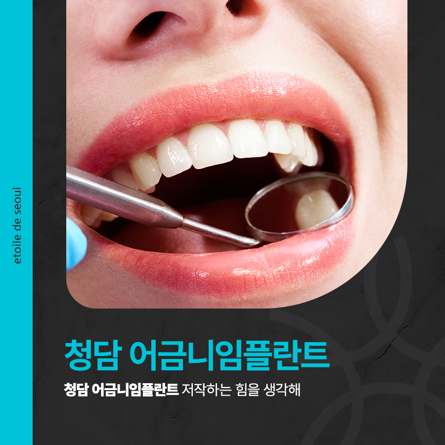청담 어금니임플란트 저작하는 힘을 생각해 관련 이미지 1