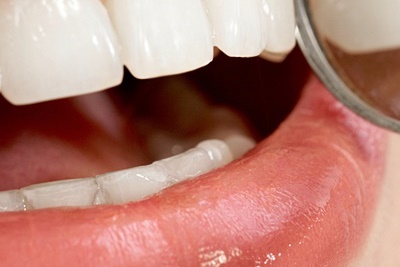 청담동치과 추천 앞니가 부러졌어요! 관련 이미지 23