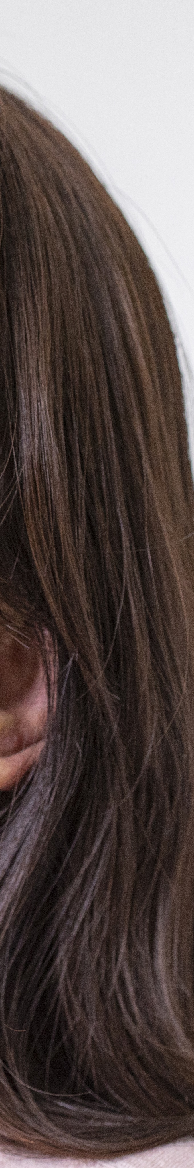 아랫니 라미네이트 숨겨왔던 미소를 되찾는 여정 관련 이미지 30