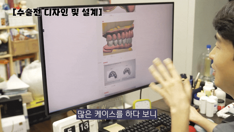 임플란트보험적용나이 기준을 체크하자 관련 이미지 8