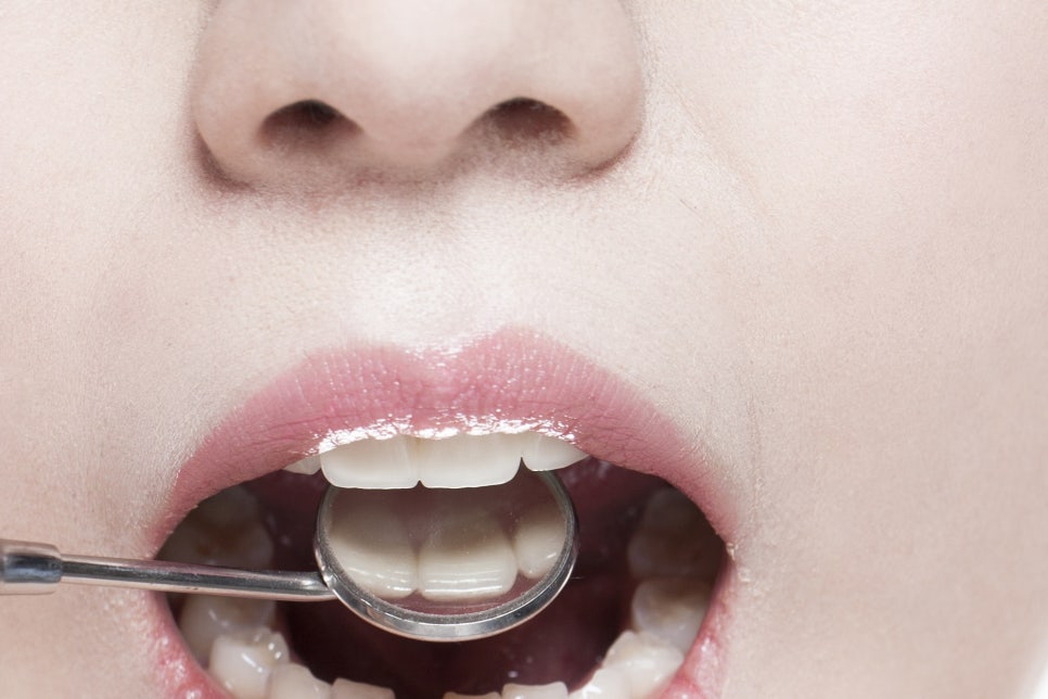 압구정로데오 임플란트틀니 새로운 미소를 찾아요 관련 이미지 19