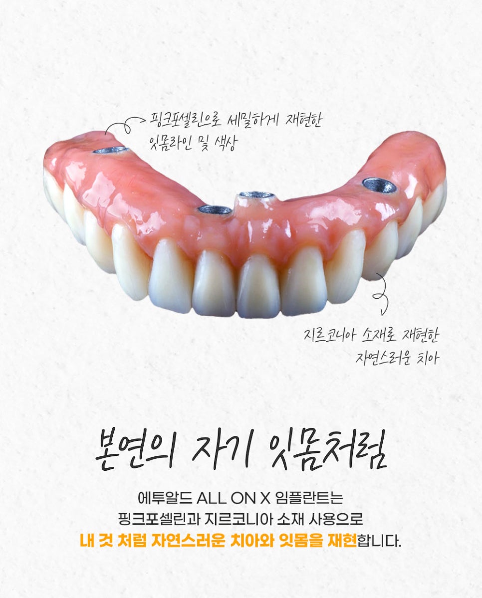 풀아치임플란트 정품 치과를 확인해야해요! 임플란트 하실 분 주목!! 관련 이미지 6