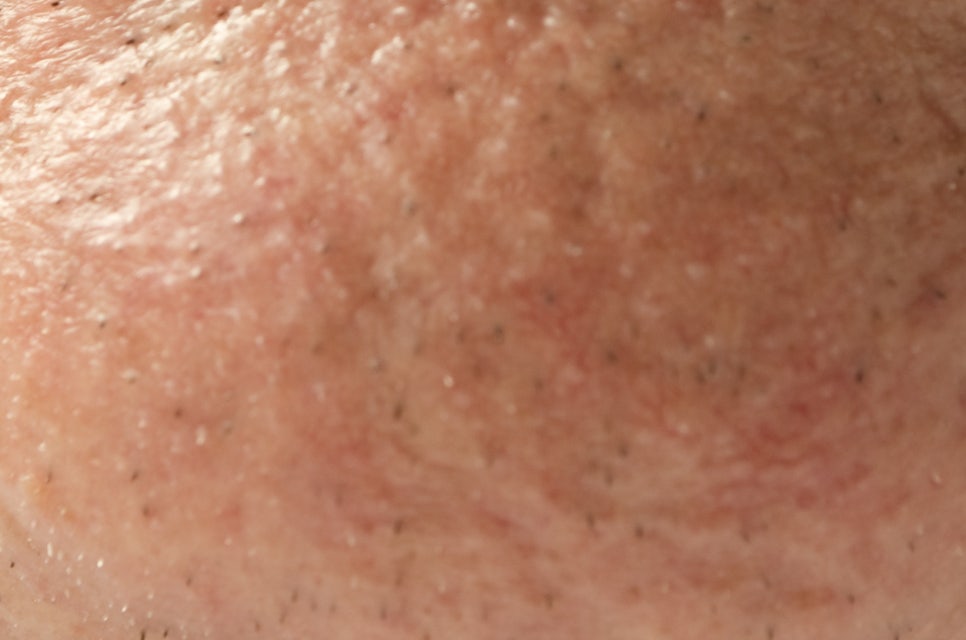 압구정로데오역 치과 불편한 틀니 대신 풀아치 임플란트! 관련 이미지 26