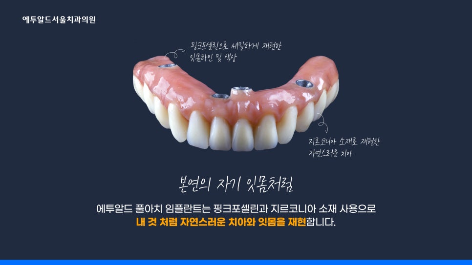 디지털 풀아치 임플란트 정말 두달이면 다 끝나나요? 관련 이미지 7