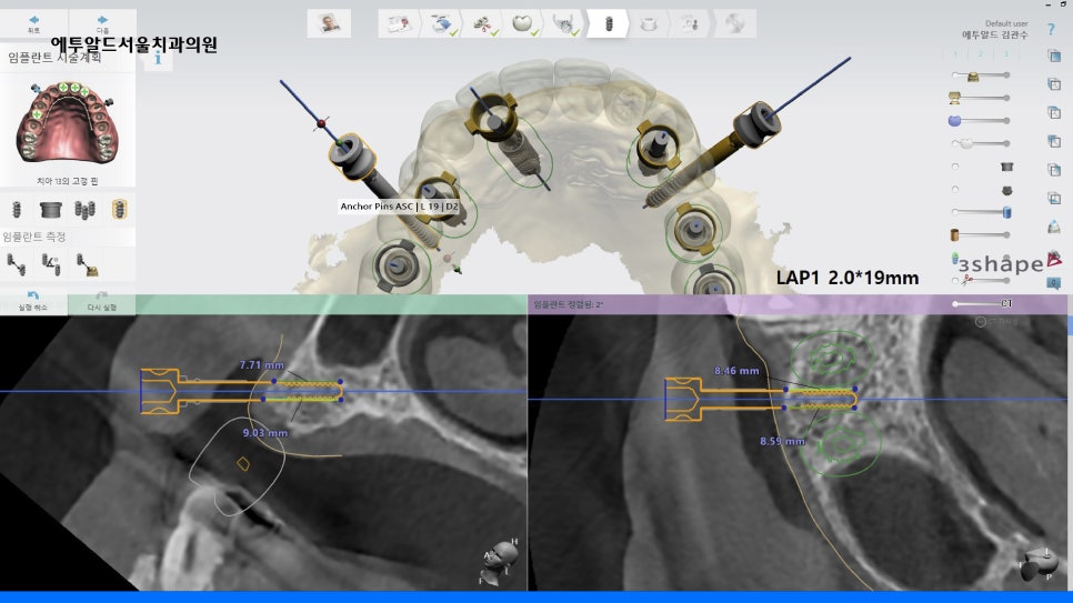 디지털풀아치 임플란트 누가 적합한가요? 관련 이미지 6