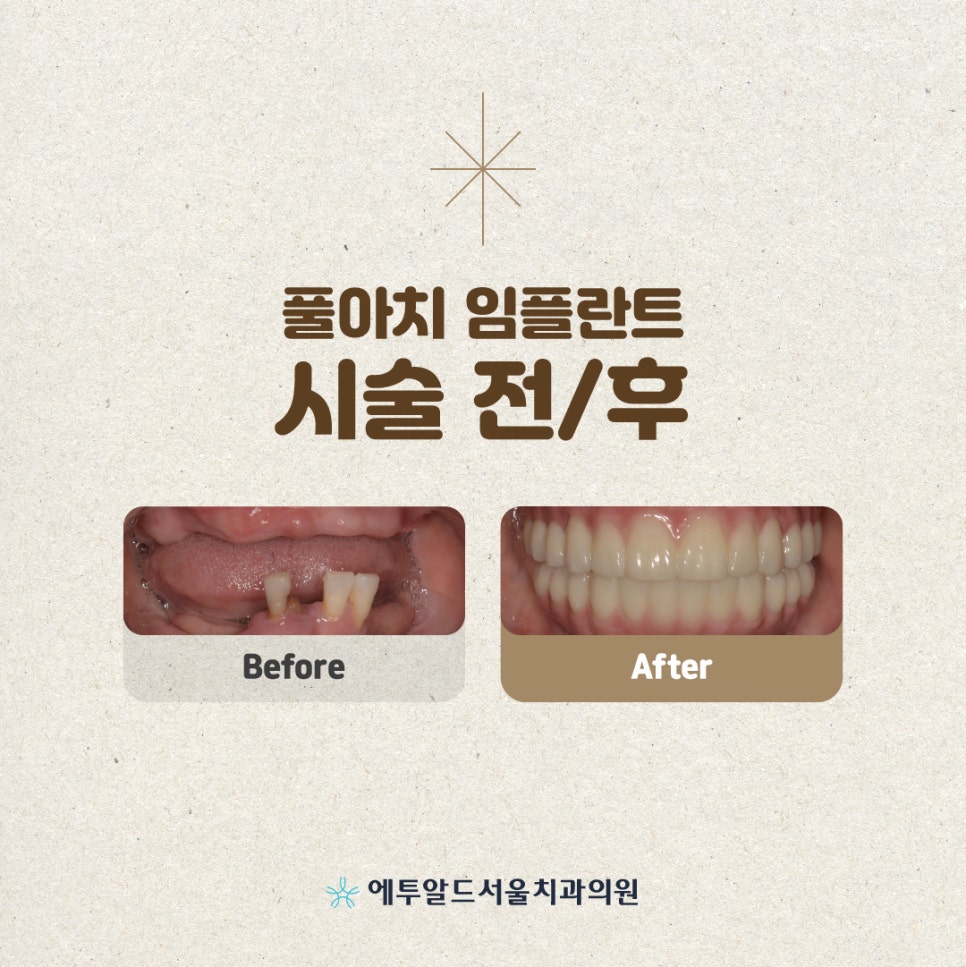 디지털 풀아치 임플란트 정말 두달이면 다 끝나나요? 관련 이미지 10