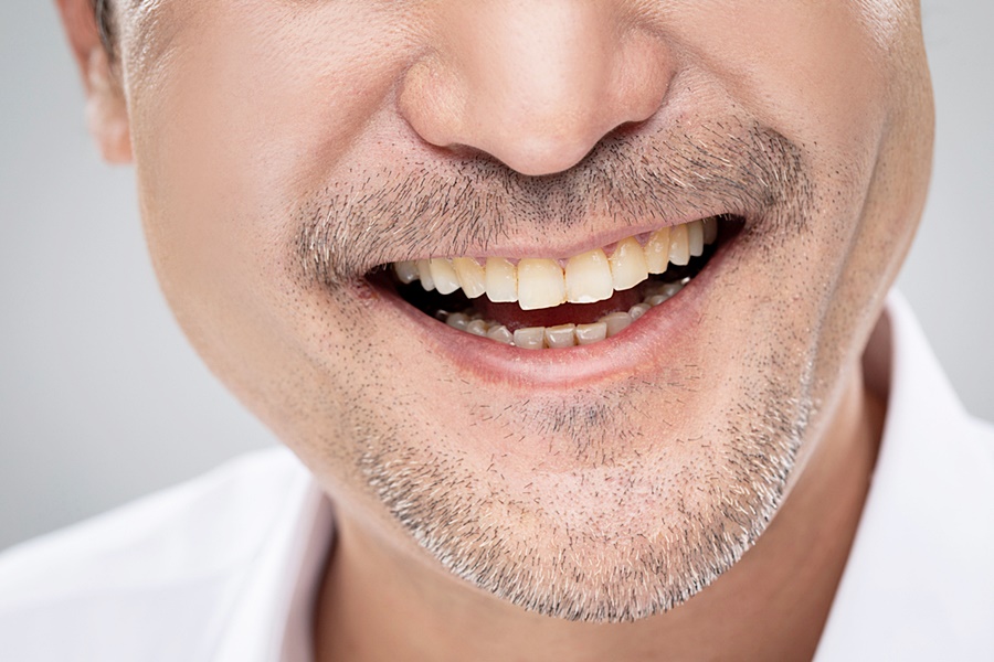 풀아치임플란트 치료기간 얼마나 걸릴까요 관련 이미지 6