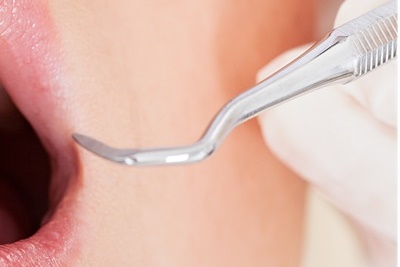 청담동치과 추천 앞니가 부러졌어요! 관련 이미지 15