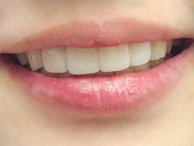 앞니 세라믹라미네이트 가격 차이나는 이유 관련 이미지 5