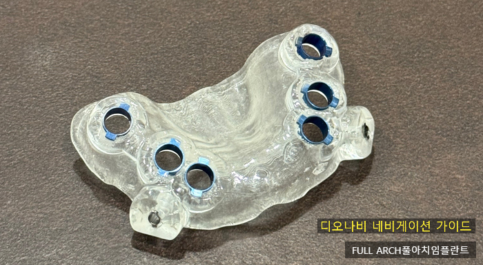 임플란트의 역사와 구조, 풀아치 임플란트 구조 차이점 비교 관련 이미지 6