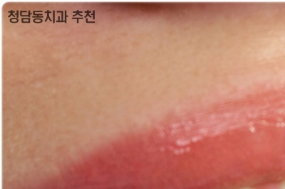 청담동치과 추천 앞니가 부러졌어요! 관련 이미지 19