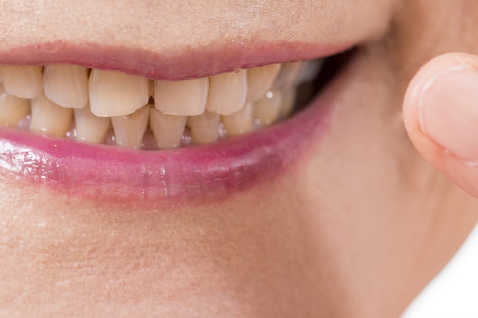 강남 65세이상임플란트 이것만 참고하자! 관련 이미지 13